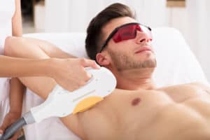 epilazione laser uomo